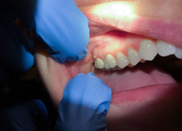 Best Emergency Dentist for Knocked-Out Tooth in New Lexington, OH
